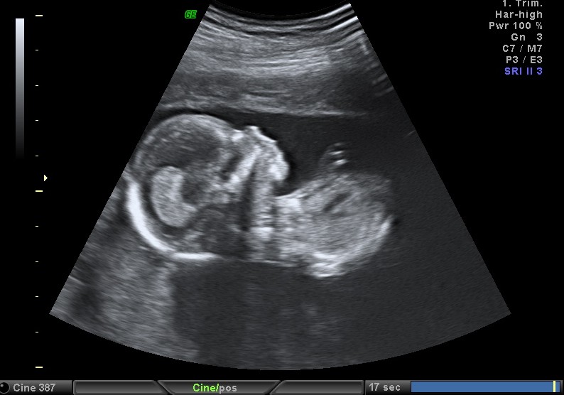 Фото узи 15 16 недель беременности фото